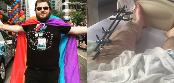 Justin Morissette wearing a rainbow flag as a cape / his leg with metalwork after surgery