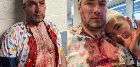 Rob and Patrick covered in blood following a homophobic hate crime in Birmingham