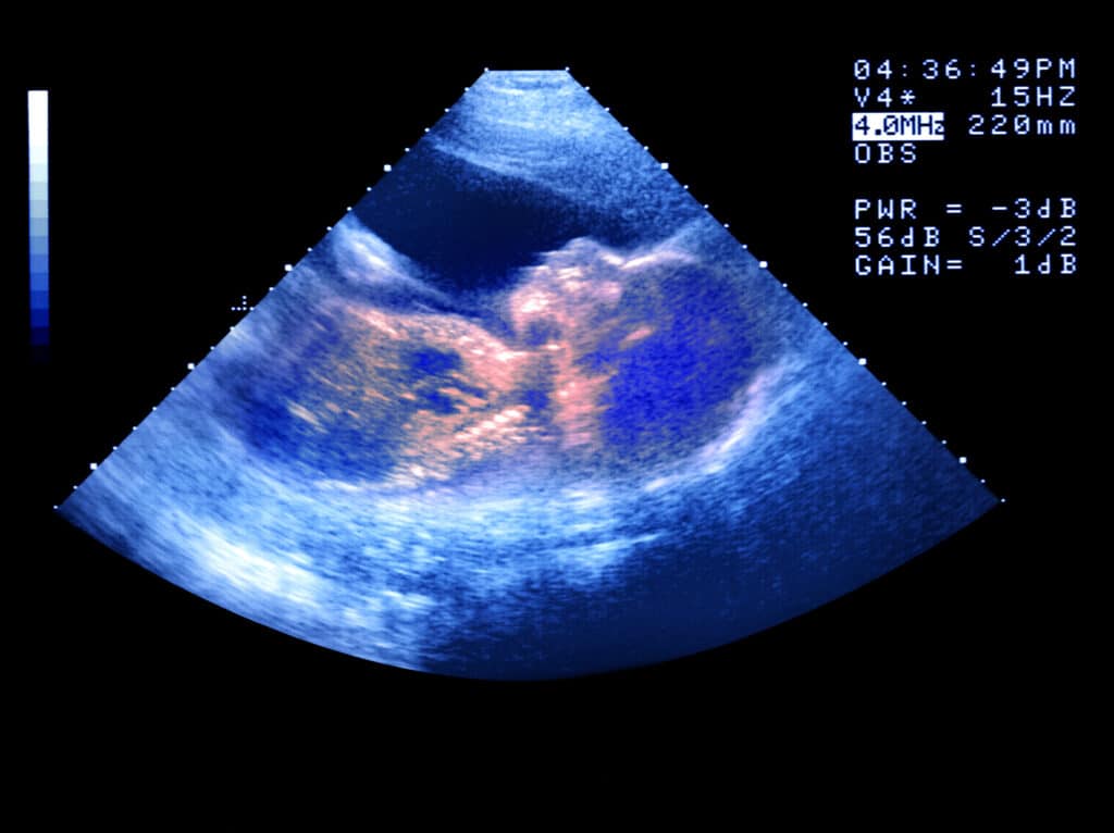 Baby scan lit up in blue and pink