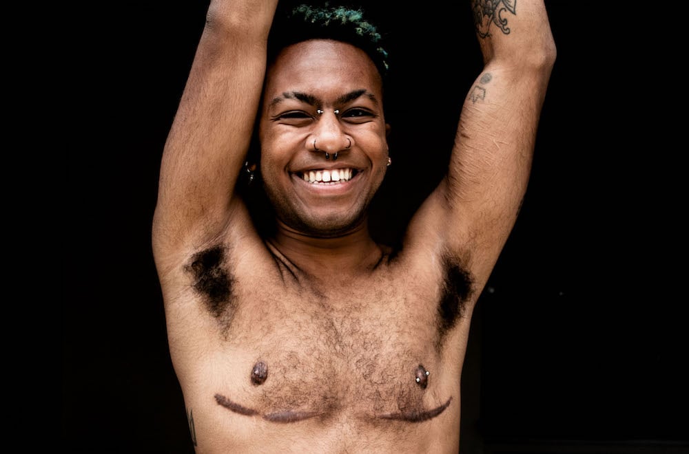 A happy, smiling transmasculine person with top surgery scars