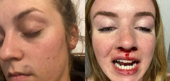 Pictures of the injuries that Emma MacLean sustained following the alleged assault.