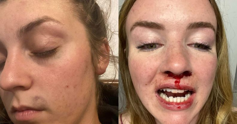 Pictures of the injuries that Emma MacLean sustained following the alleged assault.