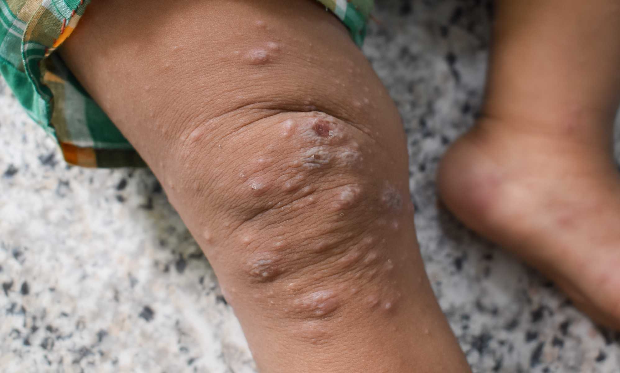 Ongoing Mpox outbreak declared a 'global threat' by Africa CDC