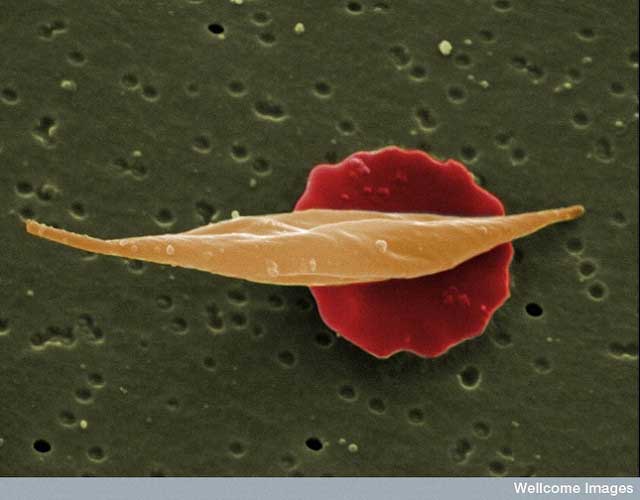 A normal blood cell behind a human blood cell of a sickle cell anaemia patient.  Wellcome Images/Flickr, CC BY-NC-ND