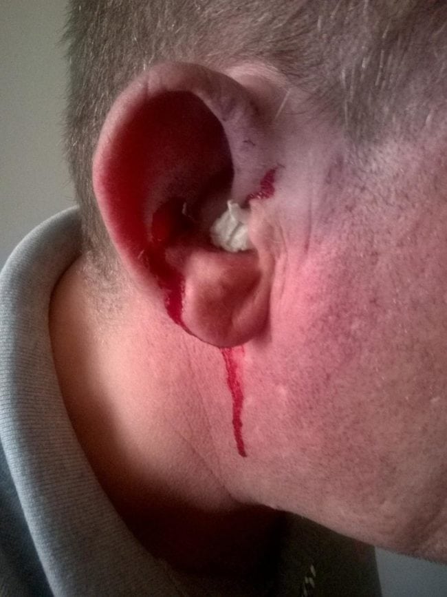 Andrew was stabbed in the ear, and has a small bleed to the brain (Andrew Williams-Coleman)