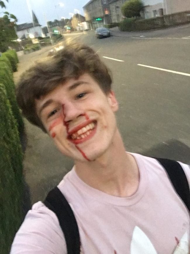 Blair Wilson bloody face smile after gay attack